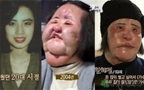 电风扇阿姨去世 整形有什么风险
